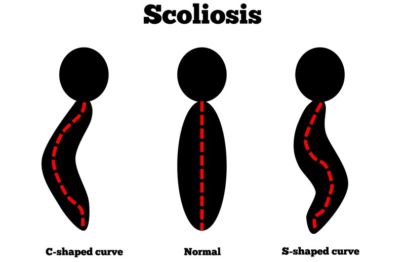 Dickson, TN scoliosis treatment